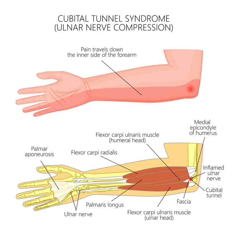Cubital Tunnel Syndrome Infographics Diagram