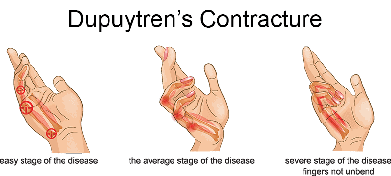 Dupuytren's Contracture infographics Diagram