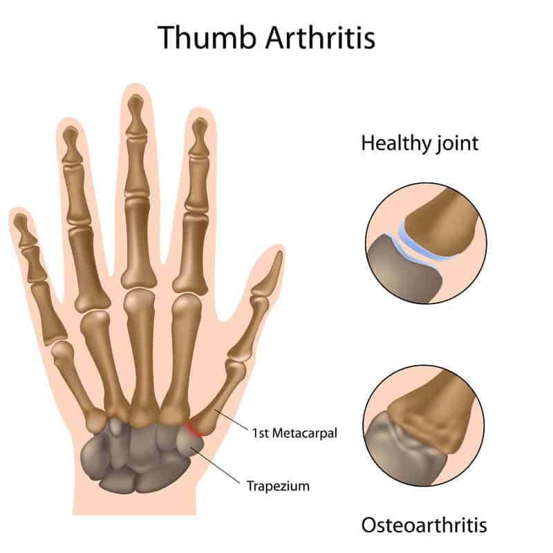 Thumb Arthritis Anatomy Diagram