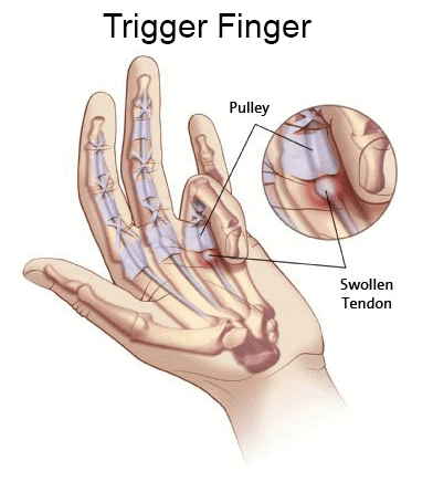 Trigger finger anatomy diagram