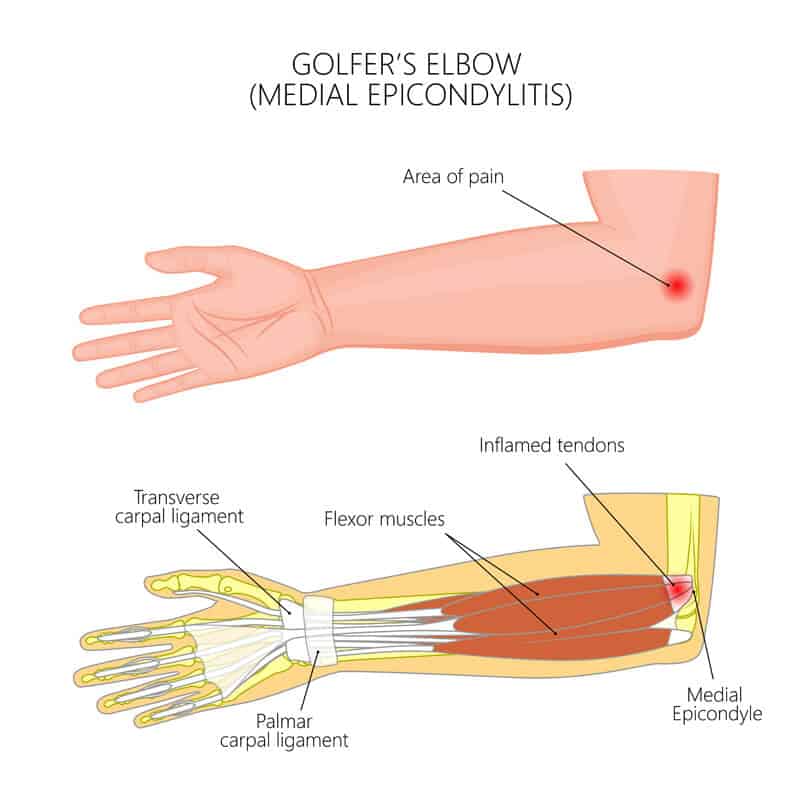 Golfer's Elbow Infographics Diagram