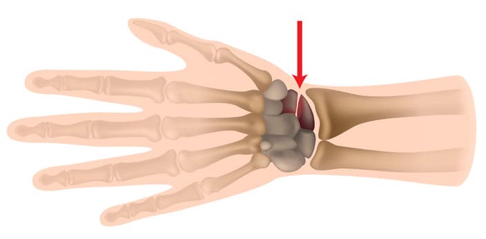 Scaphoid Fracture Infographics Diagram