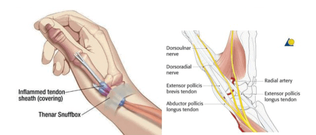 De Quervains Tenosynovitis Infographics Diagram