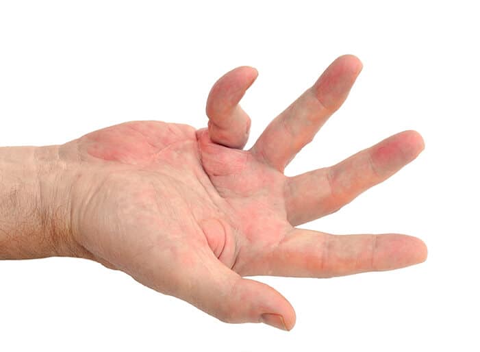 hand with dupuytrens contracture