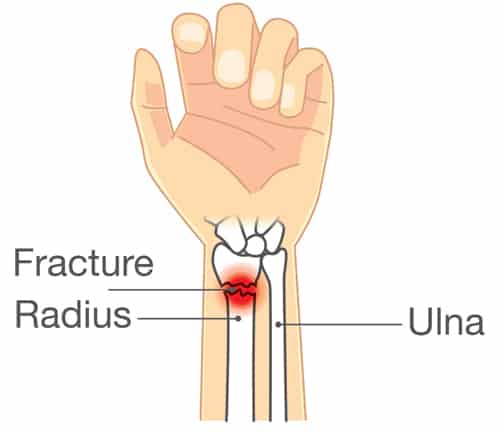 Distal Radius Fracture Infographics Diagram