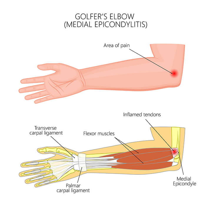 Golfer's Elbow anatomical view