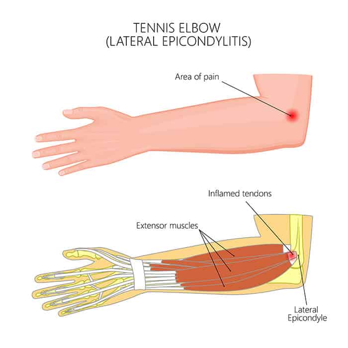 Tennis elbow anatomical view