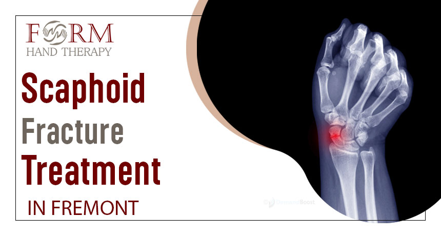 Scaphoid Fracture Treatment in Fremont